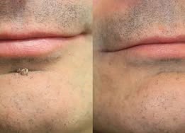 ✨Muwix®2-in-1 Microneedle & Hydrocolloid Patch🍀| Removes Raised Moles, Acne, Flat Warts & Skin Tags | Helps Improve Wrinkles, Scars & Blemishes | Invisible Patches for Face & Body
