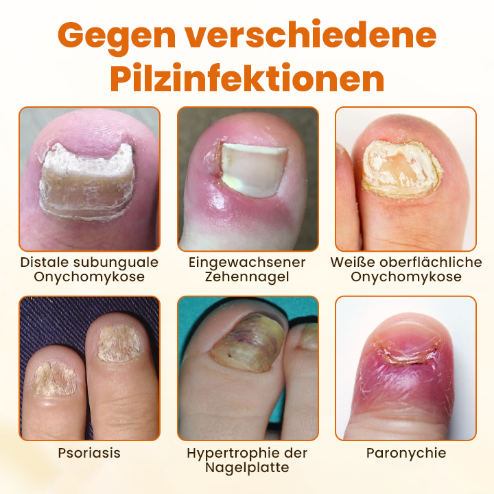 Timilk® Hochwertiges Spray zur Nagelpflege