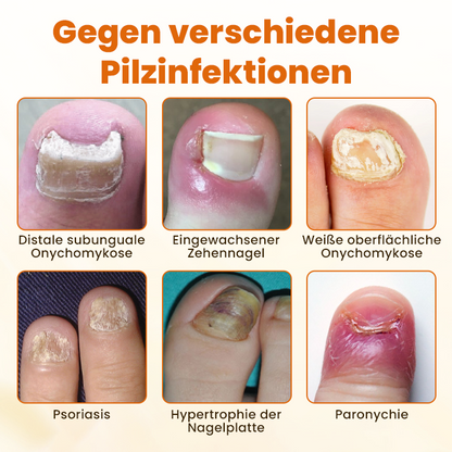 Timilk® Hochwertiges Spray zur Nagelpflege