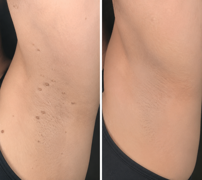 ✨Muwix®2-in-1 Microneedle & Hydrocolloid Patch🍀| Removes Raised Moles, Acne, Flat Warts & Skin Tags | Helps Improve Wrinkles, Scars & Blemishes | Invisible Patches for Face & Body