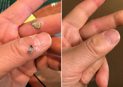 ✨Muwix®2-in-1 Microneedle & Hydrocolloid Patch🍀| Removes Raised Moles, Acne, Flat Warts & Skin Tags | Helps Improve Wrinkles, Scars & Blemishes | Invisible Patches for Face & Body